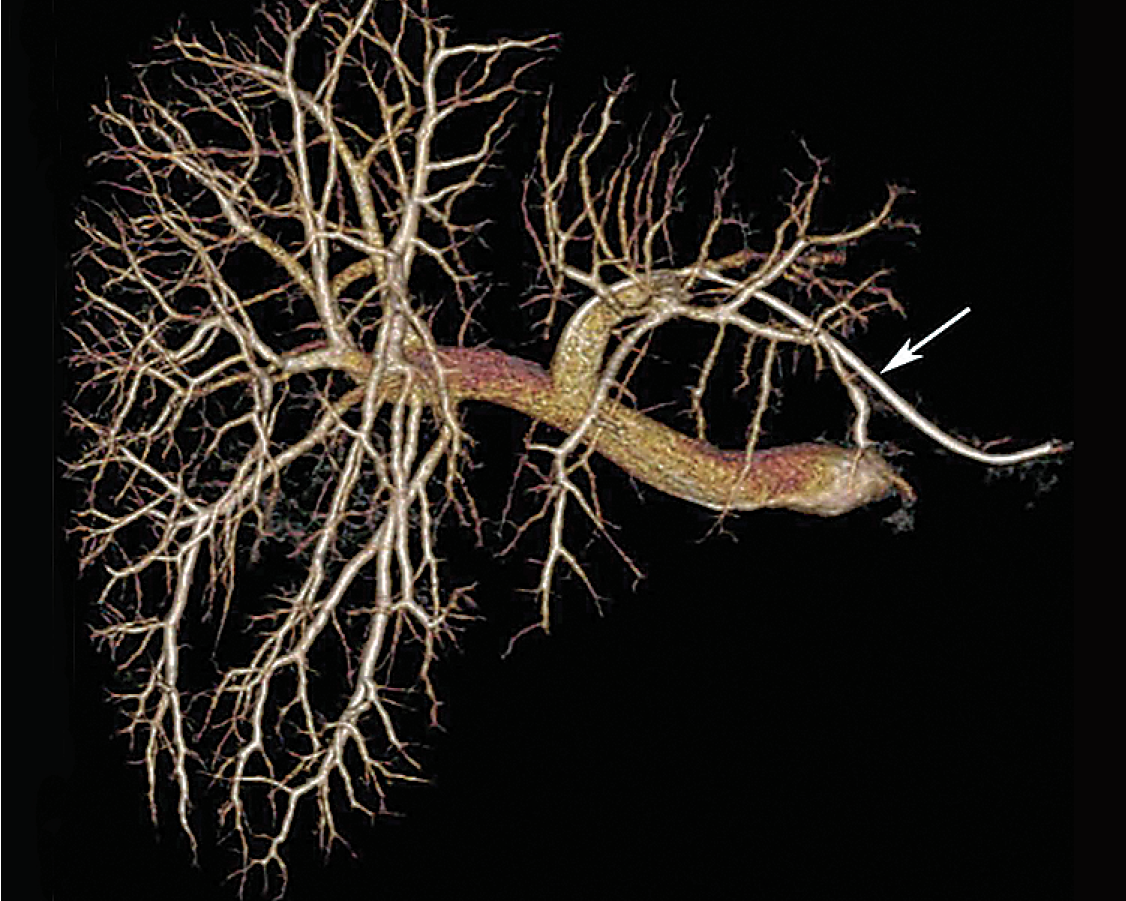 A 3D portogram obtained via 5-F catheter